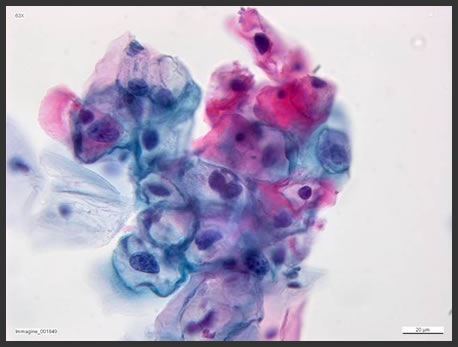 Cellule infettate da HPV